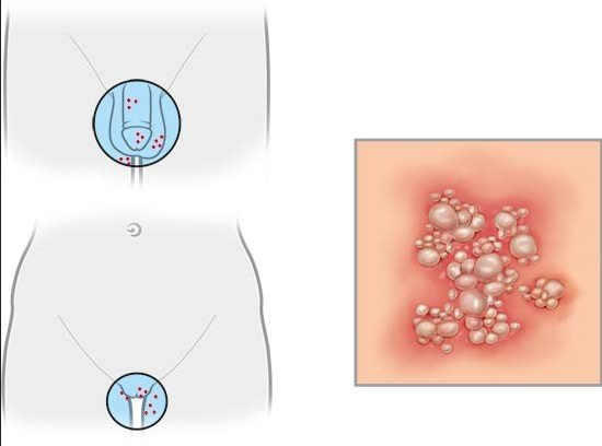 Genitalherpes