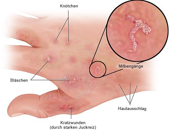 Krätze an der Hand - Scabies